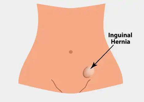 Inguinal Hernia