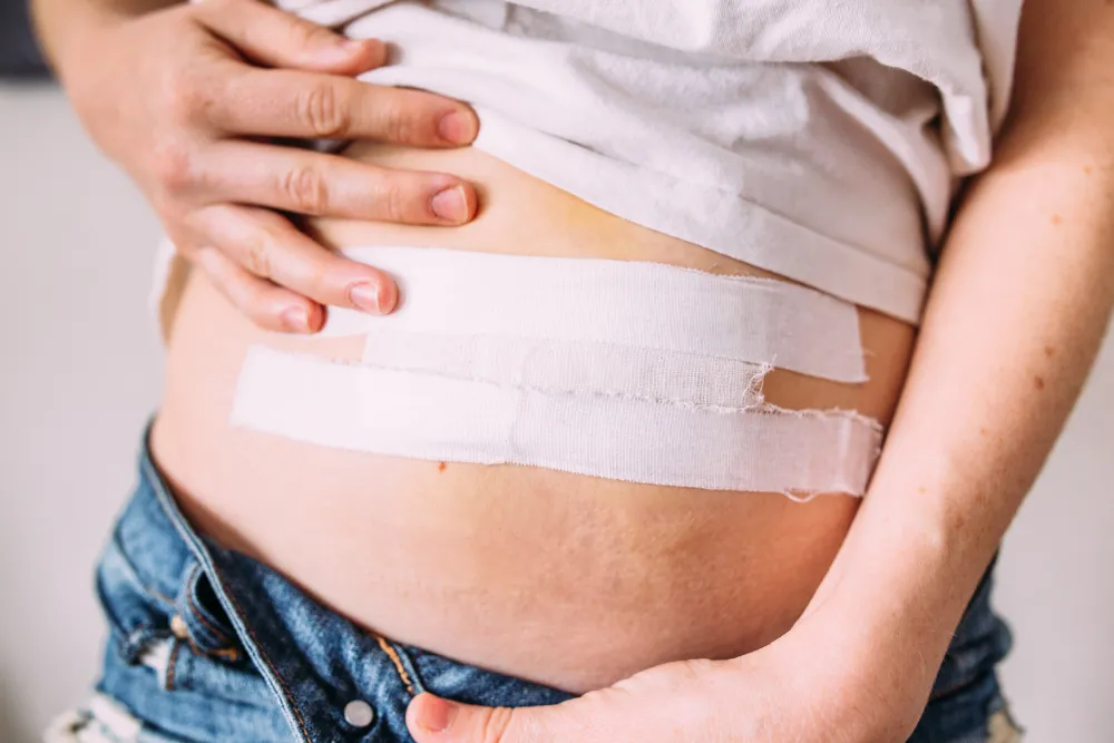 Person with a bandaged abdominal incision following hernia repair surgery during recovery