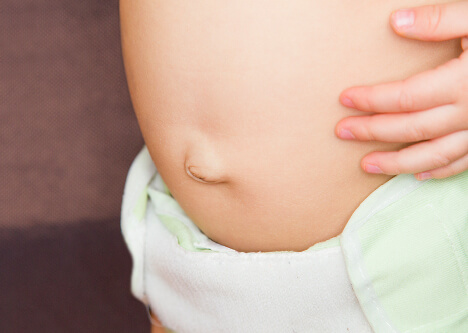 Umbilical Hernia 